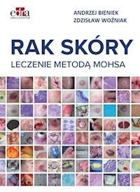 Rak skóry Leczenie metodą Mohsa - Bieniek Andrzej, Woźniak Zdzisław - książka