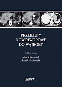 Przerzuty nowotworowe do wątroby -  - książka