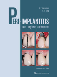 Peri-Implantitis - Ioannis K. Karoussis - ebook