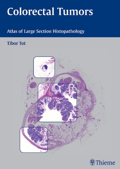 Colorectal Tumors - Tibor Tot - ebook - Legimi online