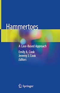 Hammertoes -  - ebook