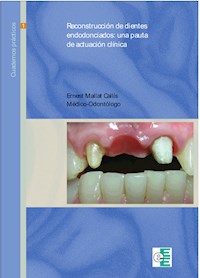Reconstrucción de dientes endodonciados - Ernest Mallat Callís - ebook