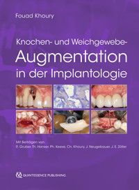 Knochen- und Weichgewebeaugmentation in der Implantologie -  - ebook